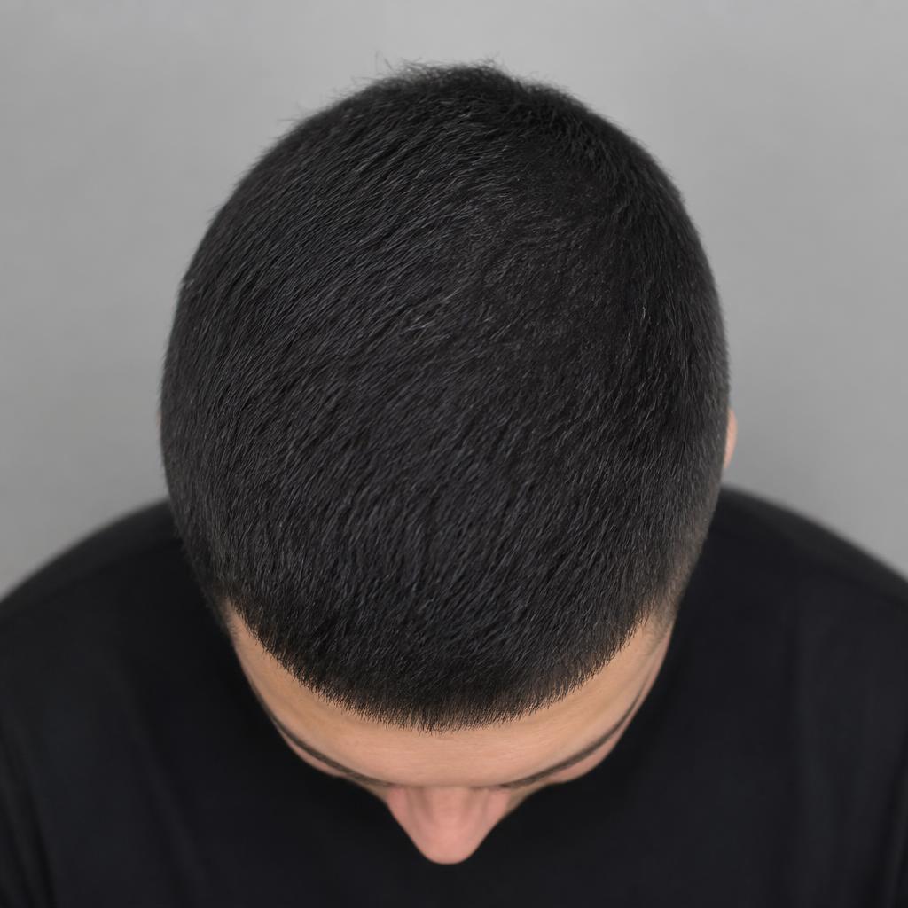 Crown density before and after — after treatment